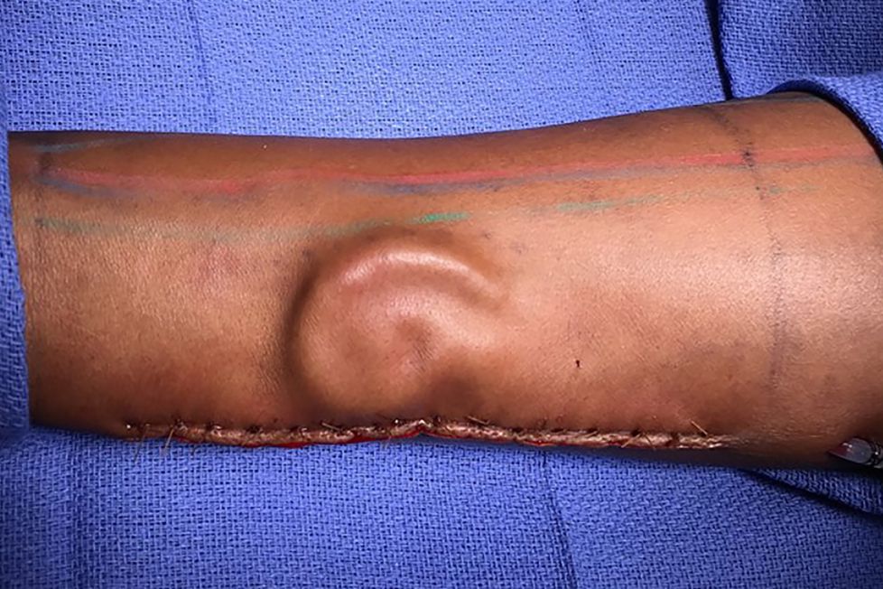 Doctors give soldier new ear after growing it in her arm